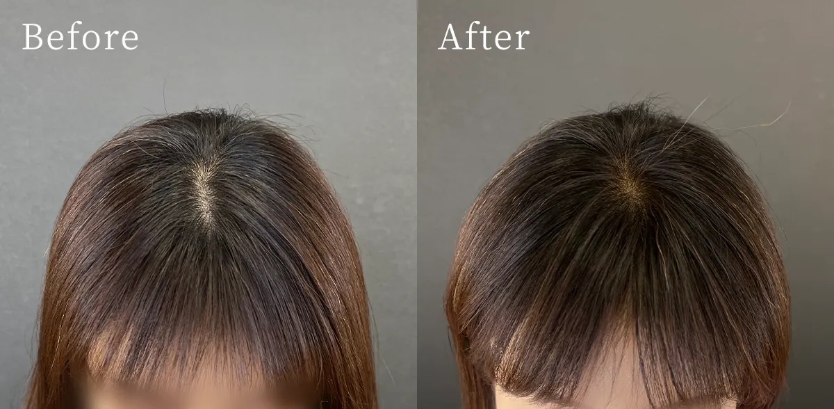 iPSF頭皮投与プログラム（頭皮注入）症例 Before After 2